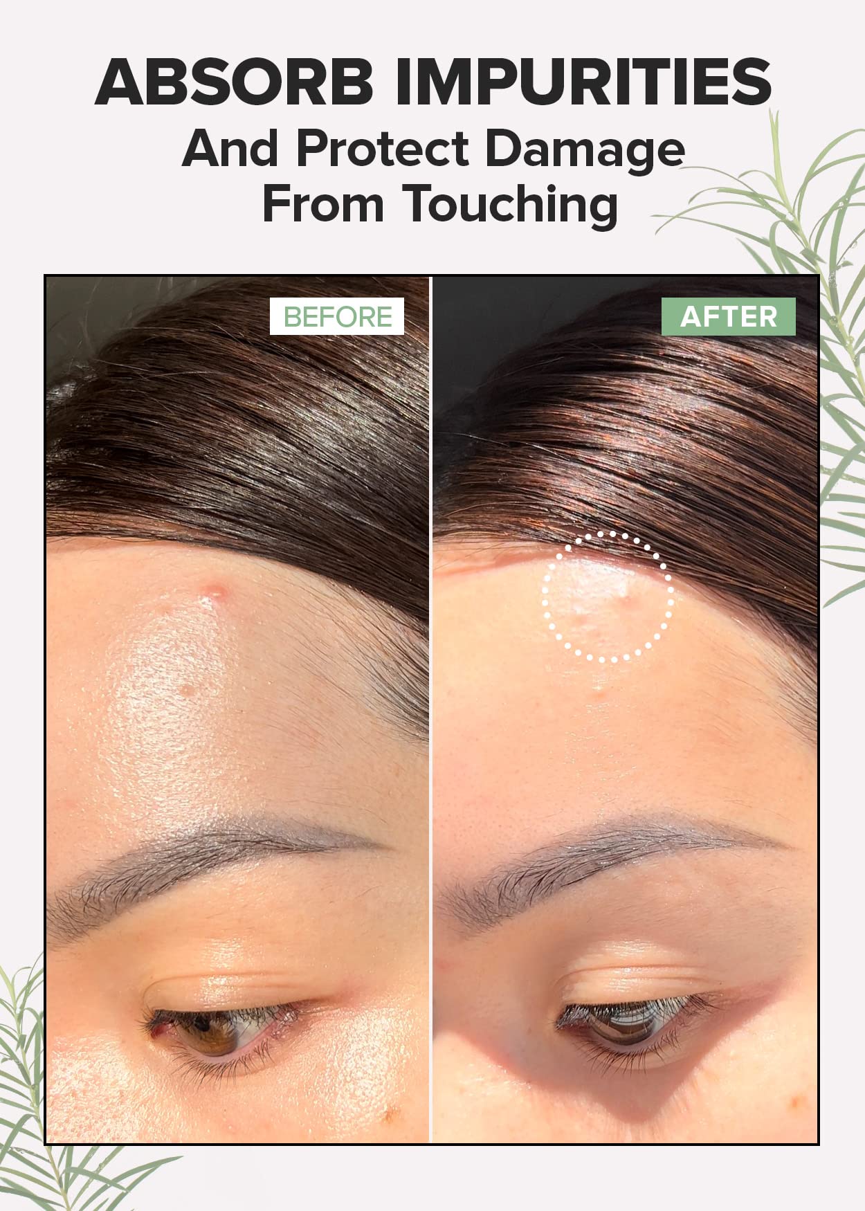 I DEW CARE Hydrocolloid Acne Pimple Patch Trio - 96 Count | Vegan, Cruelty-Free & Gluten-Free Acne Treatment | Perfect for Overnight Spot Treatment & On-the-Go Skincare
