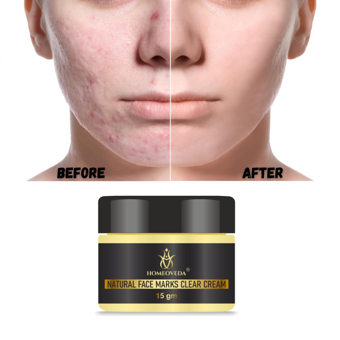 Homeoveda Natural Face Marks Clear Cream - Reduces Acne, Pimples, Blemishes, Pigmentation & Stretch Marks | 15gm | Organic Skincare Solution for Clear, Healthy Skin | Perfect for Daily Use & Post-Acne Care