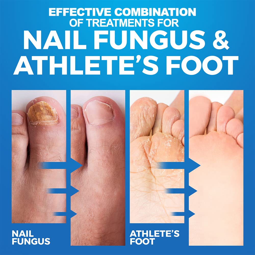 Best Fungal Nail Treatment & Athlete's Foot Cream Set - Fast-Acting Antifungal Solution for Toenail & Foot Care - Perfect for Gym, Pool & Home Use