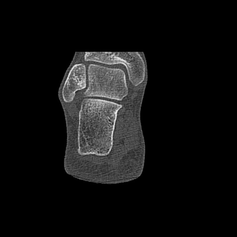 Foot Phantom Metatarsal Fractures Model - Realistic CT Scan & X-Ray Training Tool for Medical Students & Radiologists - Perfect for Anatomy Study & Diagnostic Practice