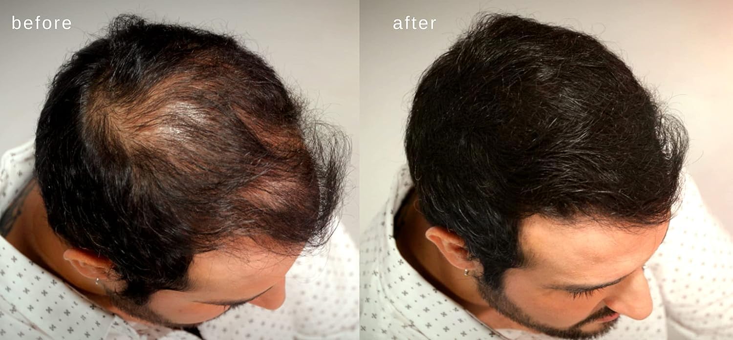 Hair Building Fiber 25g - Black Hair Thickening Fibers for Instant Volume & Coverage | Perfect for Thinning Hair & Bald Spots | Salon-Quality Results at Home