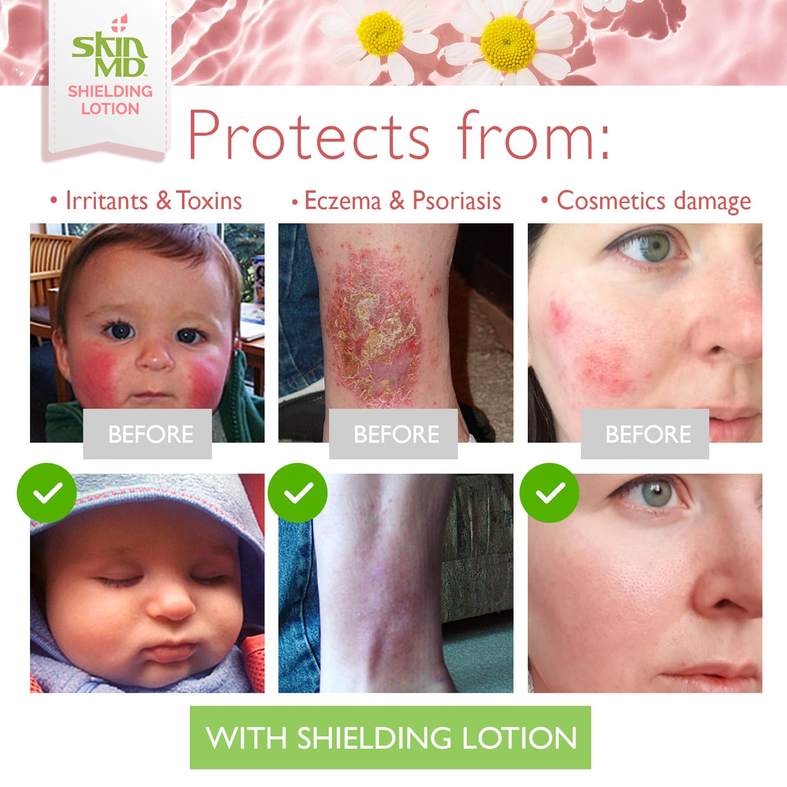 Skin MD Shielding Lotion - Hydrating Body Lotion for Sensitive Skin | Non-Greasy, Fast-Absorbing Moisturizer with Plant-Based Ingredients | Lotion for Dry Skin, Eczema & Psoriasis Relief (1 Gallon) | Perfect for Daily Use, Post-Shower Hydration & Skin Therapy