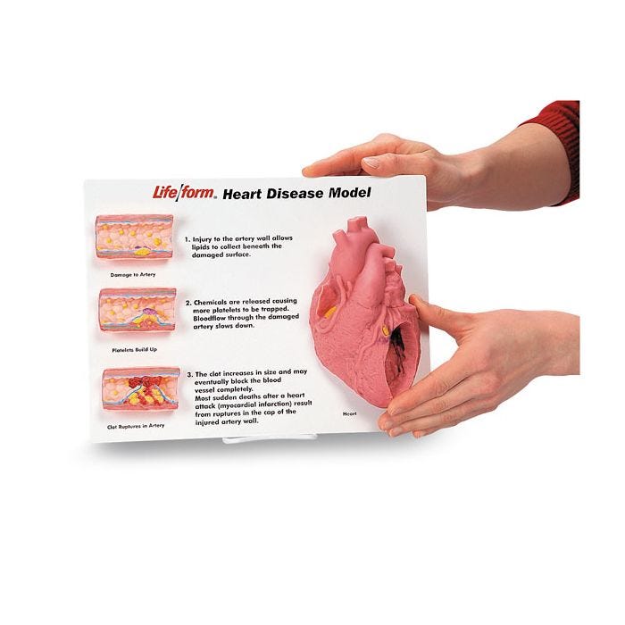 3D Heart Disease Display Model - Anatomical Heart Model for Medical Education & Training - Perfect for Doctors, Students & Healthcare Professionals