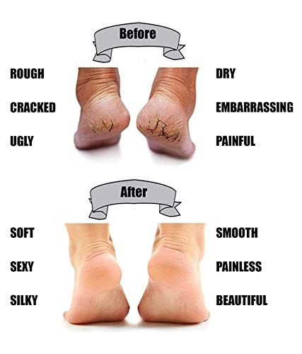 Marvy® Silicone Gel Heel Pad Socks for Pain Relief - Anti Crack Heel Protectors for Men & Women (Beige, One Size Fits All, Pack of 5) - Perfect for Dry Cracked Heels, Plantar Fasciitis & Diabetic Foot Care