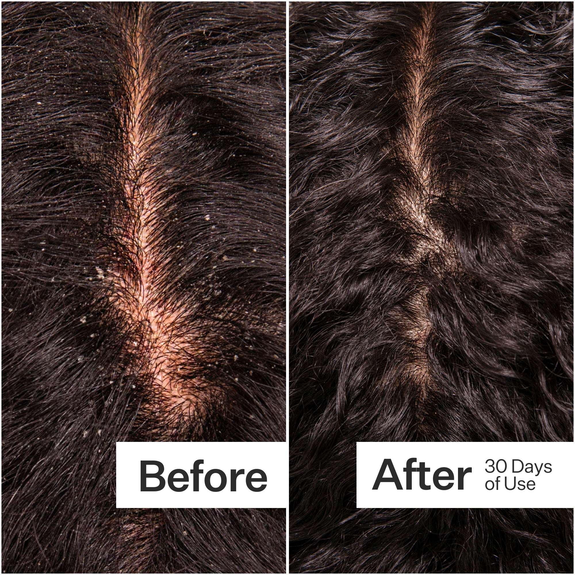 Act + Acre Microbiome Cooling Scalp Serum for Dry & Itchy Scalp - Soothing Treatment for Dandruff & Irritation - Perfect for Daily Hair Care Routine & Scalp Refreshment
