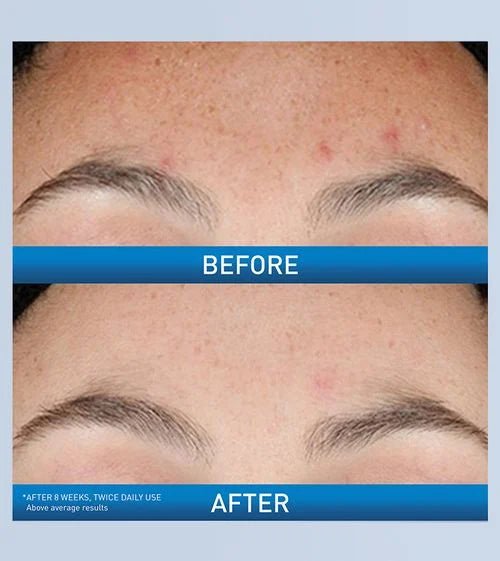 CeraVe Resurfacing Retinol Serum for Face - Anti-Aging & Skin Renewal Treatment - Reduce Wrinkles & Dark Spots - Perfect for Night Skincare Routine & Daily Use