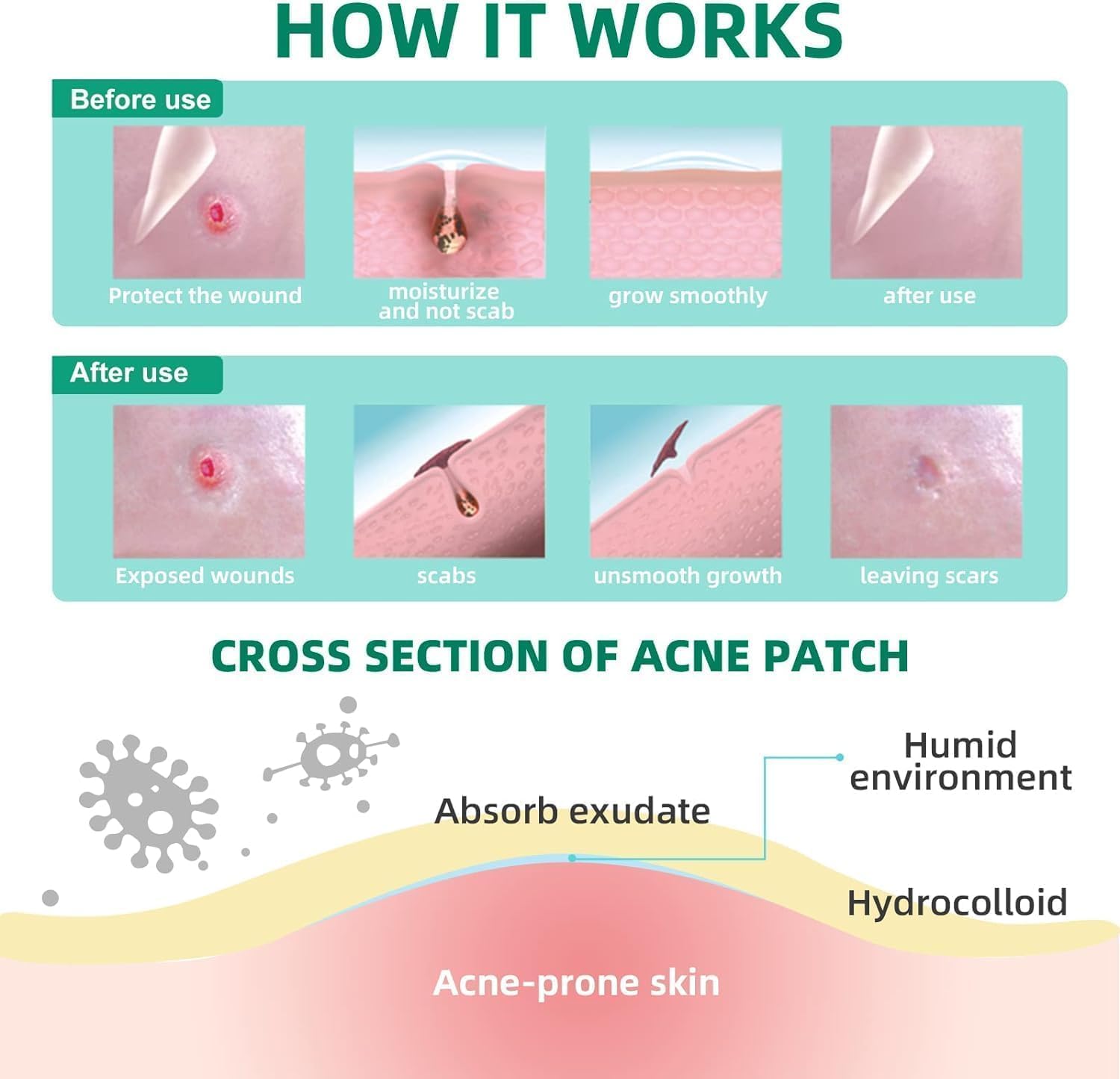 ACOTYE Hydrocolloid Pimple Patches with Salicylic Acid & Tea Tree Oil for Large Zits - Face, Chin & Back Acne Treatment (210 Count) - Perfect for Overnight Spot Treatment & Daily Breakout Care