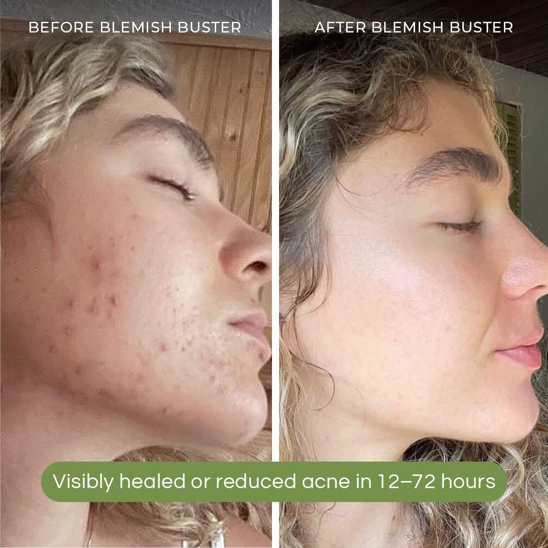 SONYA DAKAR Blemish Buster - Acne Spot Treatment with Salicylic Acid & Sulfur for Clear Skin | Camphor & Probiotics (Lactobacillus/Bifidobacterium) | Tinted Clean Beauty Formula .25 oz - Perfect for Daytime Use & On-the-Go Skincare