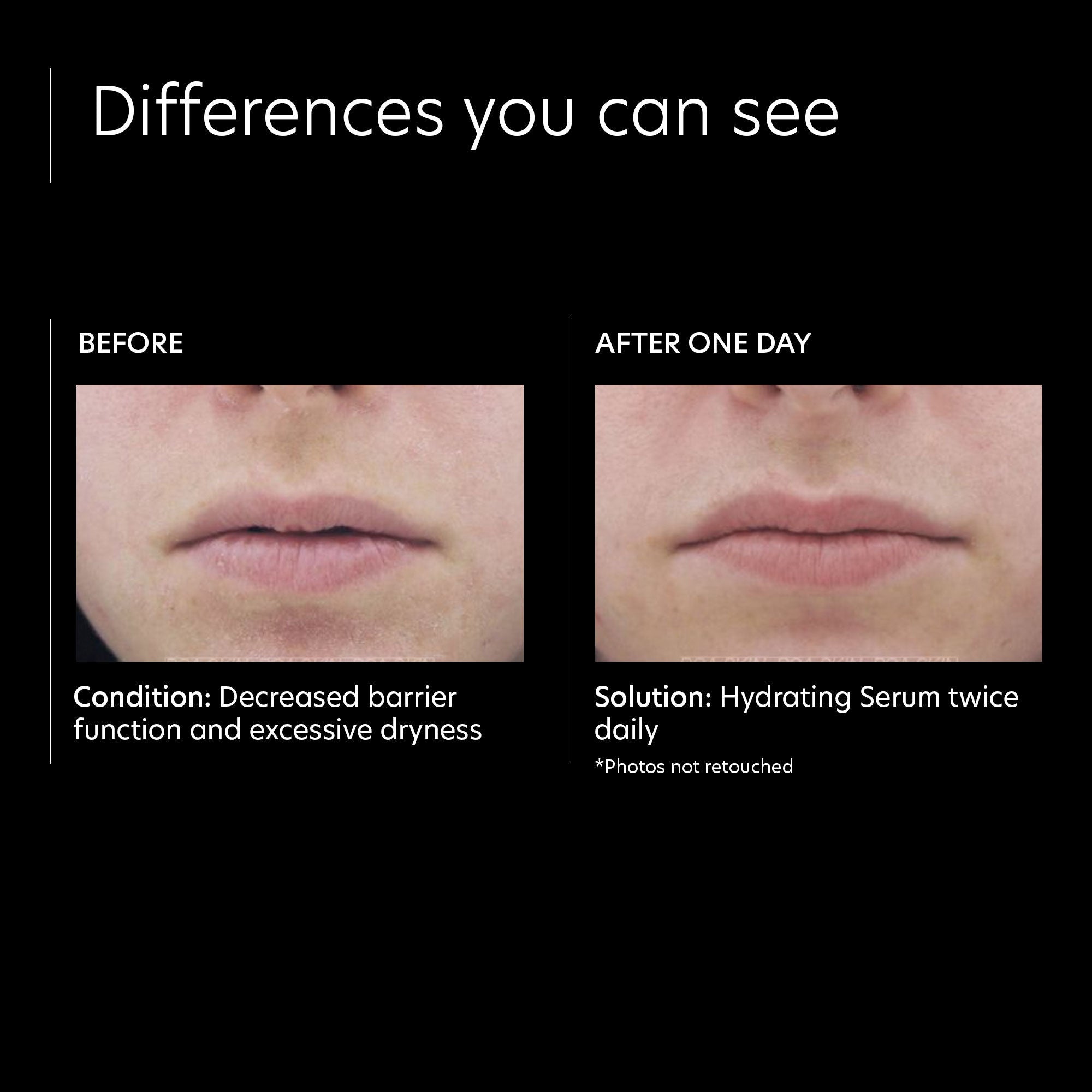 PCA Skin Hydrating Serum for Face - Hyaluronic Acid Moisturizer for Dry Skin - Anti-Aging & Hydration Boost - Perfect for Daily Skincare Routine & Nighttime Use