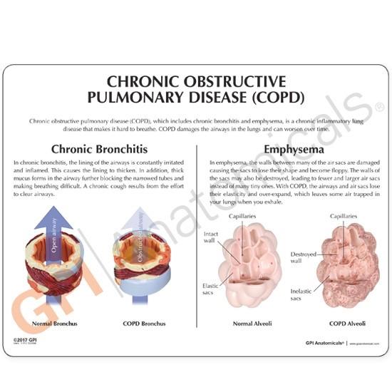 COPD 4-Piece Enlarged Anatomical Model - Medical Education Tool for Respiratory Disease Study & Classroom Demonstration