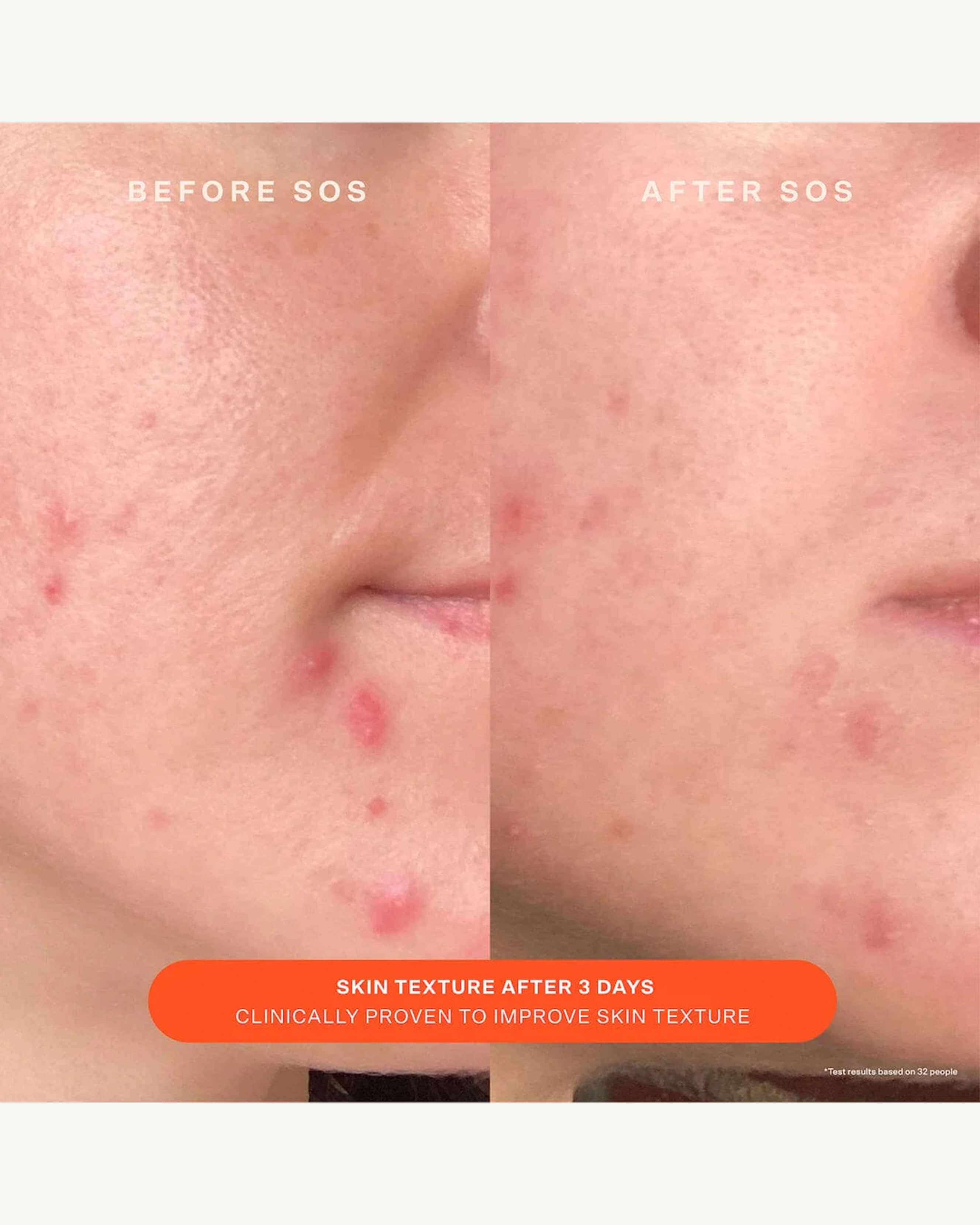 SOS Daily Barrier Recovery Cream for Dry, Sensitive Skin - Hydrating Moisturizer with Ceramides & Hyaluronic Acid - Perfect for Nighttime Skincare Routine & Post-Procedure Care