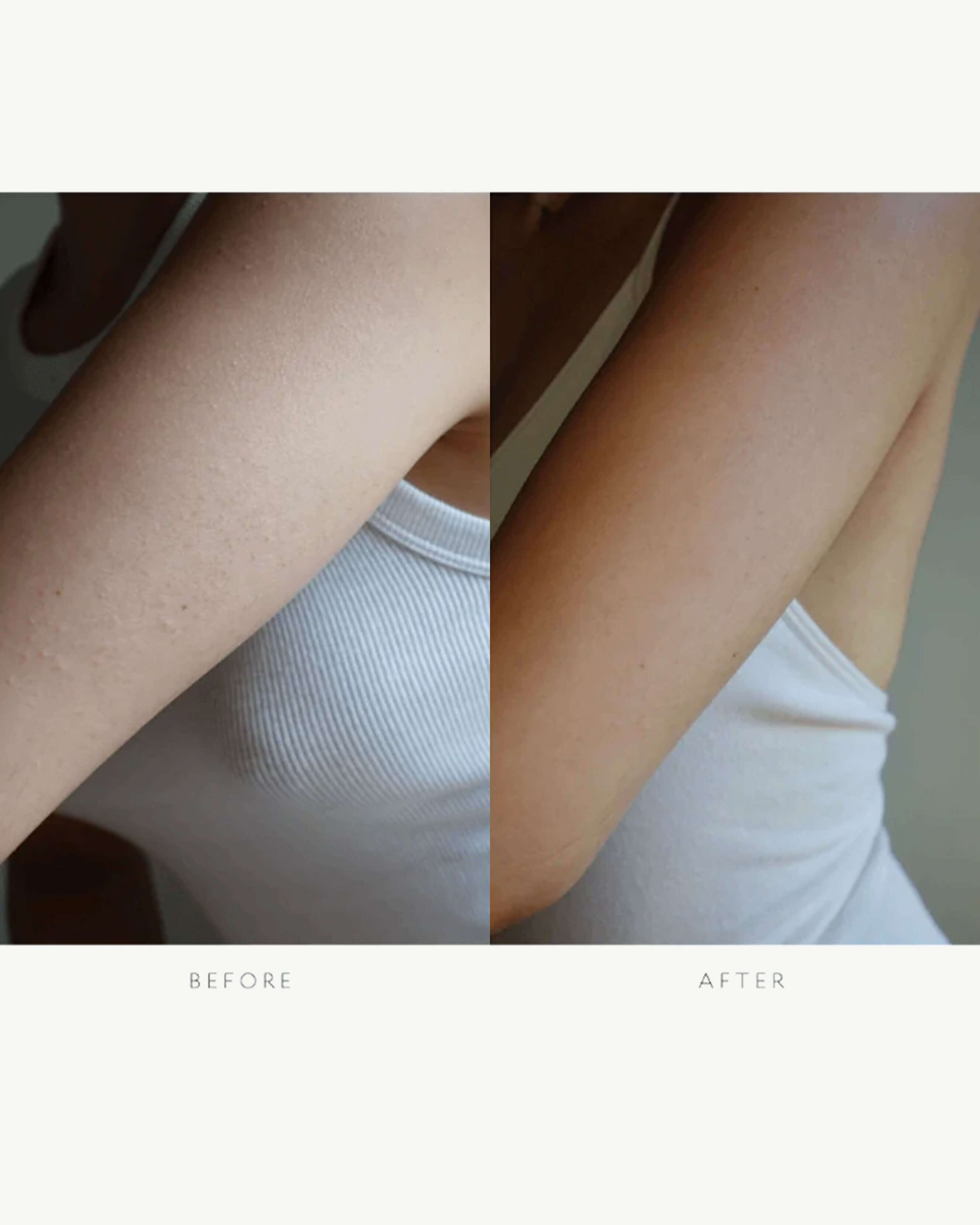 Best Resurfacing Body Serum for Smooth & Glowing Skin | Exfoliating & Hydrating Treatment | Perfect for Dry, Rough Skin & Pre-Wedding Prep