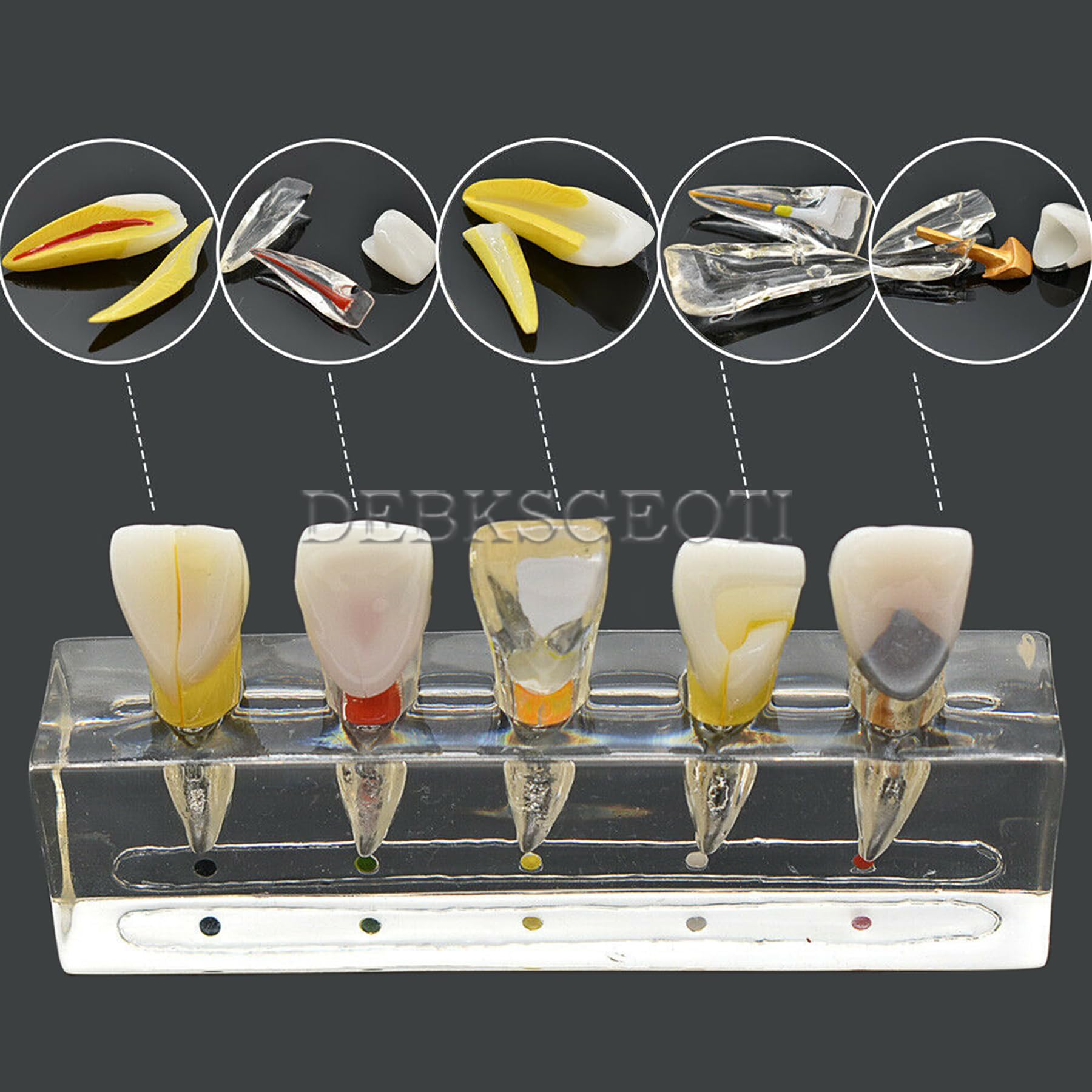 Dental Typodont Model for Caries Treatment - M4008 Anatomical Demonstration Kit for Incisor & Diseased Teeth | Dental Education, Student Practice & Clinical Training