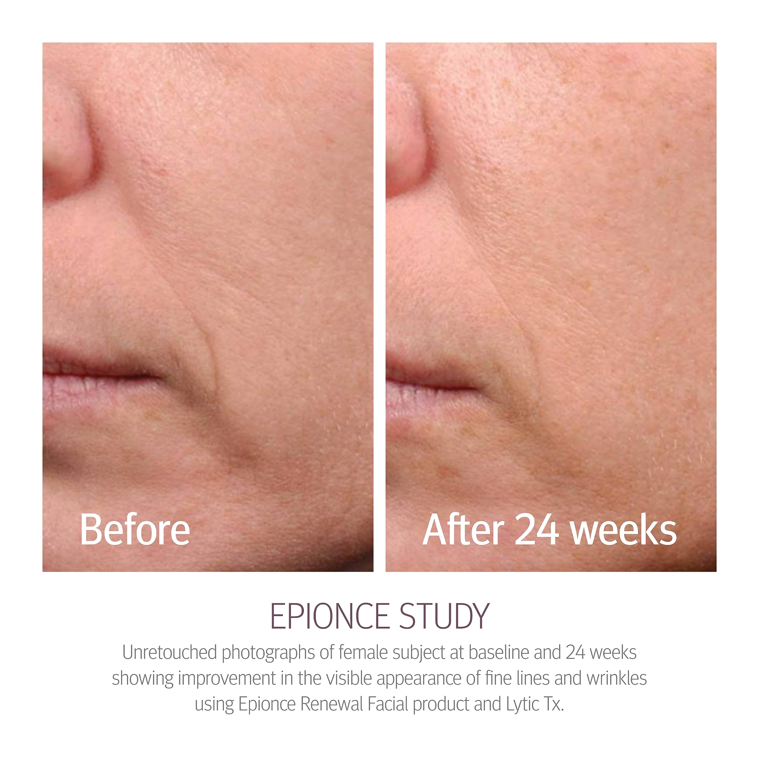 Epionce Renewal Facial Lotion - Hydrating & Anti-Aging Moisturizer for Normal to Combination Skin | Reduces Fine Lines & Wrinkles | Dermatologist Recommended Skincare | Perfect for Daily Use & Nighttime Routine