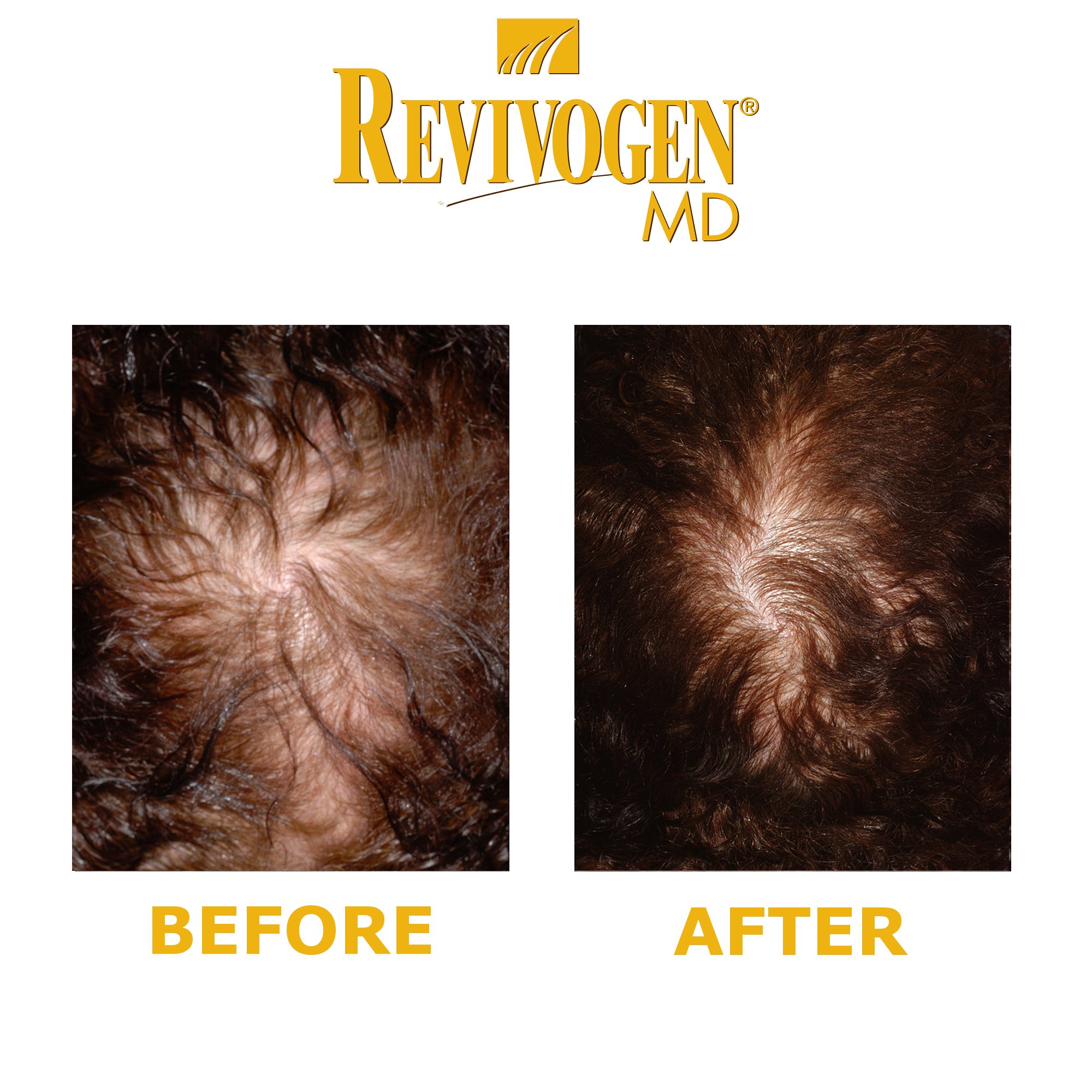 REVIVOGEN MD Scalp Therapy & Shampoo - Natural Hair Loss Treatment for Fine & Thinning Hair | DHT Blocker for Men & Women | Daily Use for Thicker, Healthier Hair Growth