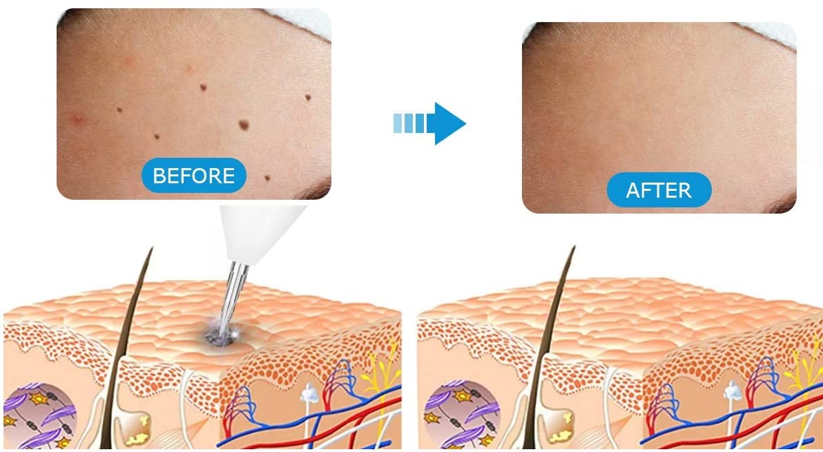 Professional Laser Mole Remover Kit - 10 Fine Needles & 1 Coarse Needle for Skin Tattoo, Freckle, Dark Spot Removal - Includes Needle Holder - Safe for Face & Body - Perfect for Home Beauty Care & Professional Use