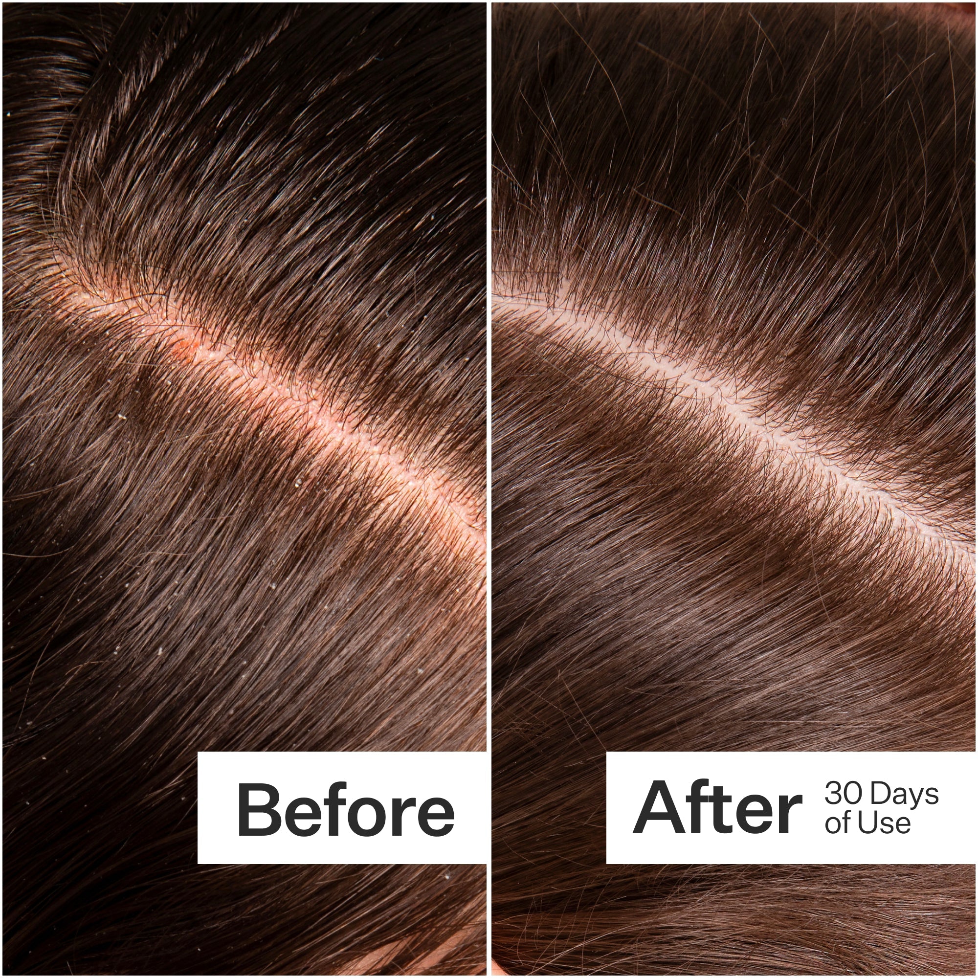 Act + Acre Microbiome Cooling Scalp Serum for Dry & Itchy Scalp - Soothing Treatment for Dandruff & Irritation - Perfect for Daily Hair Care Routine & Scalp Refreshment