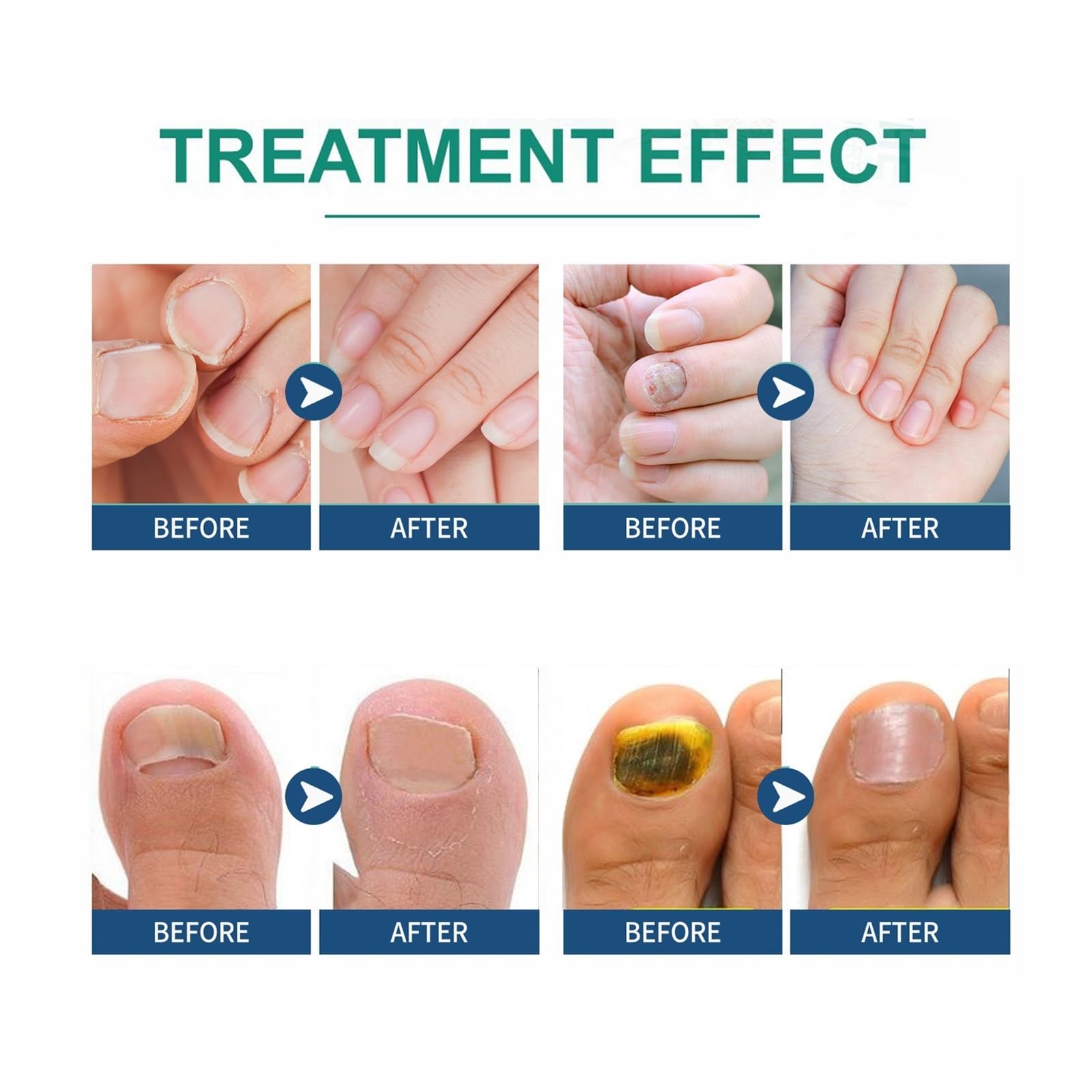 64 Pcs Nail Repair Patches - Damaged Nail Treatment for Cracked & Discolored Nails (Cream) | Strengthen & Beautify Nails for Salon-Quality Results at Home