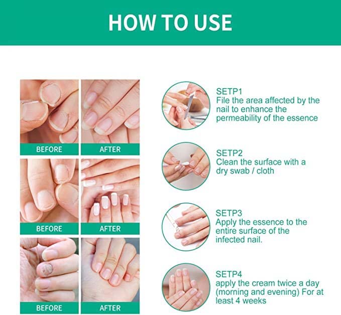 Kerassentials Toenail Fungal Treatment Oil - Extra Strong Foot & Nail Repair Kit for Fungus Relief | Athlete's Foot Care, Nail Restoration for Healthy Toes