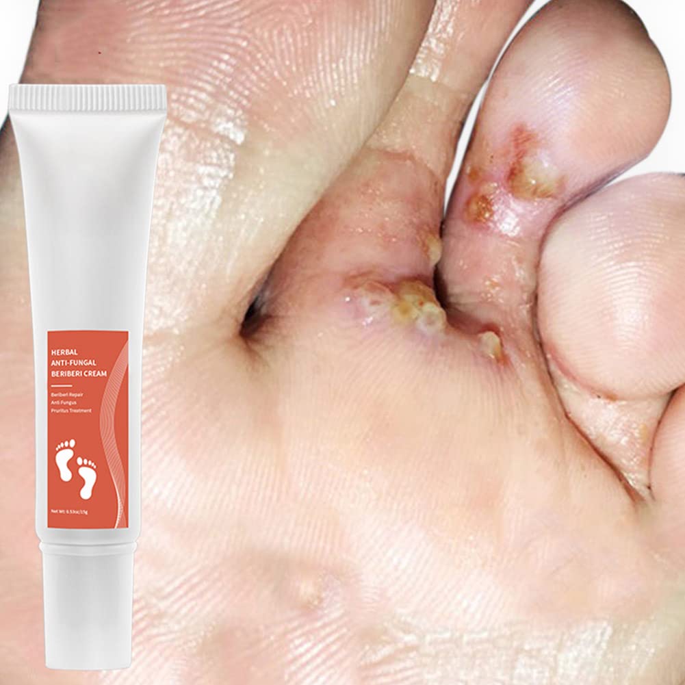 Allbesta Herbal Anti-Fungal Foot Cream - Treats Foot Infections, Reduces Inflammation & Relieves Itching - Effective for Athlete's Foot, Ringworm & Nail Fungus - Perfect for Daily Foot Care & Post-Workout Recovery