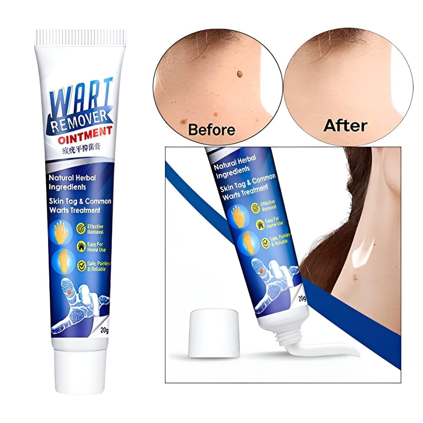 Painless Wart Remover Cream for Skin, Face & Corns - Effective Treatment for Acne, Moles, Scars & Lipoma | SIRF TUM 7 Fast-Acting Ointment | Gentle Skin Care Solution for Smooth & Clear Complexion | Perfect for Home Use & Dermatological Care