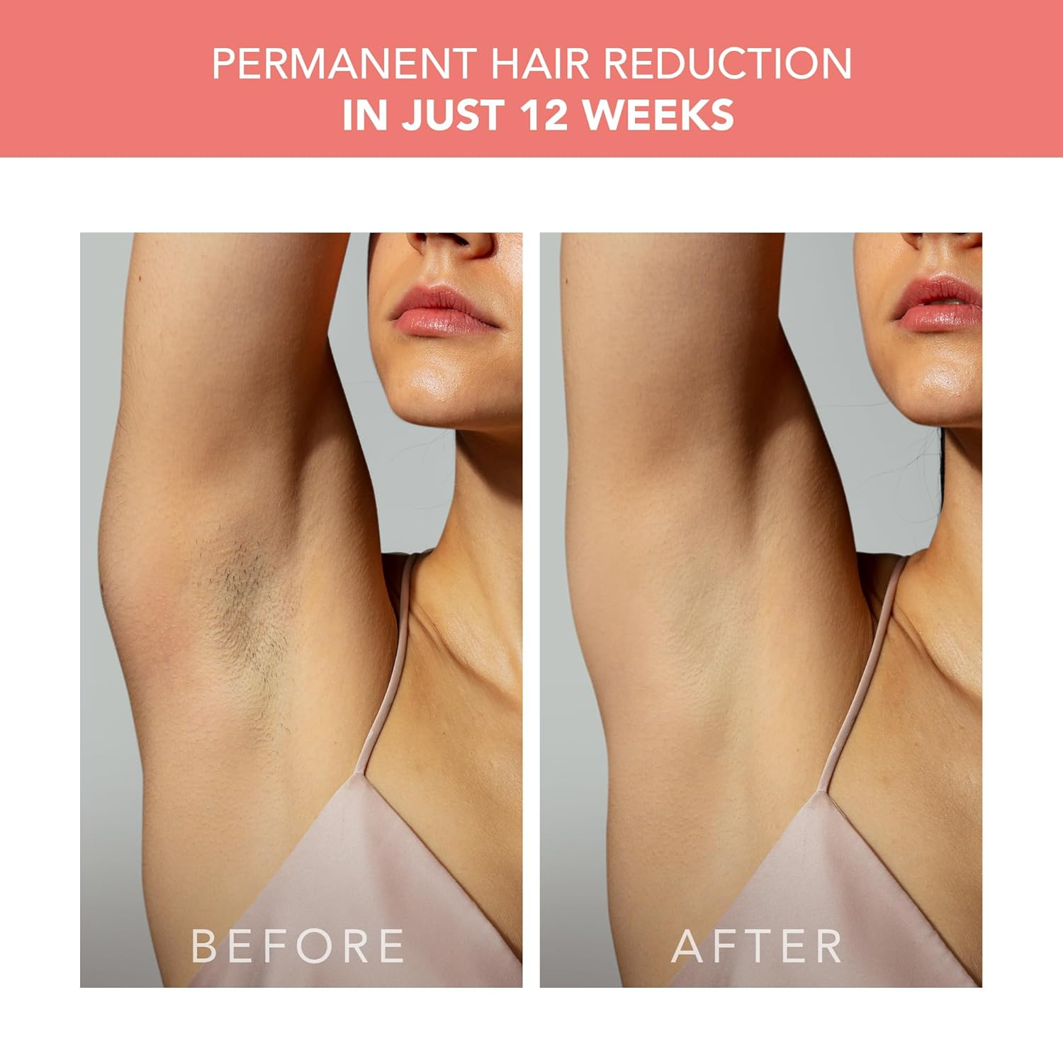 FOREO PEACH 2 IPL Hair Removal Device for Women & Men - Permanent Hair Reduction for Face, Legs, Underarms & Bikini Line - At-Home Laser Hair Removal Treatment with Smooth Skin Technology