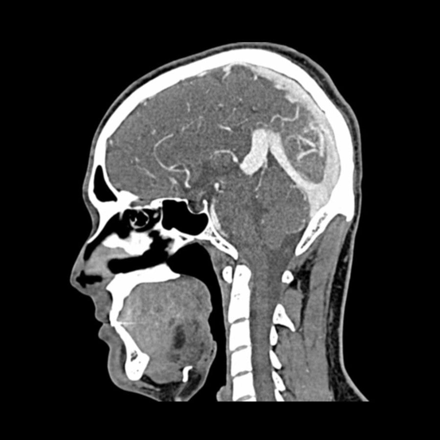 Head and Neck CTA Phantom AVM for CT Scan & X-Ray Training - Medical Imaging Practice, Radiology Education, and Diagnostic Testing