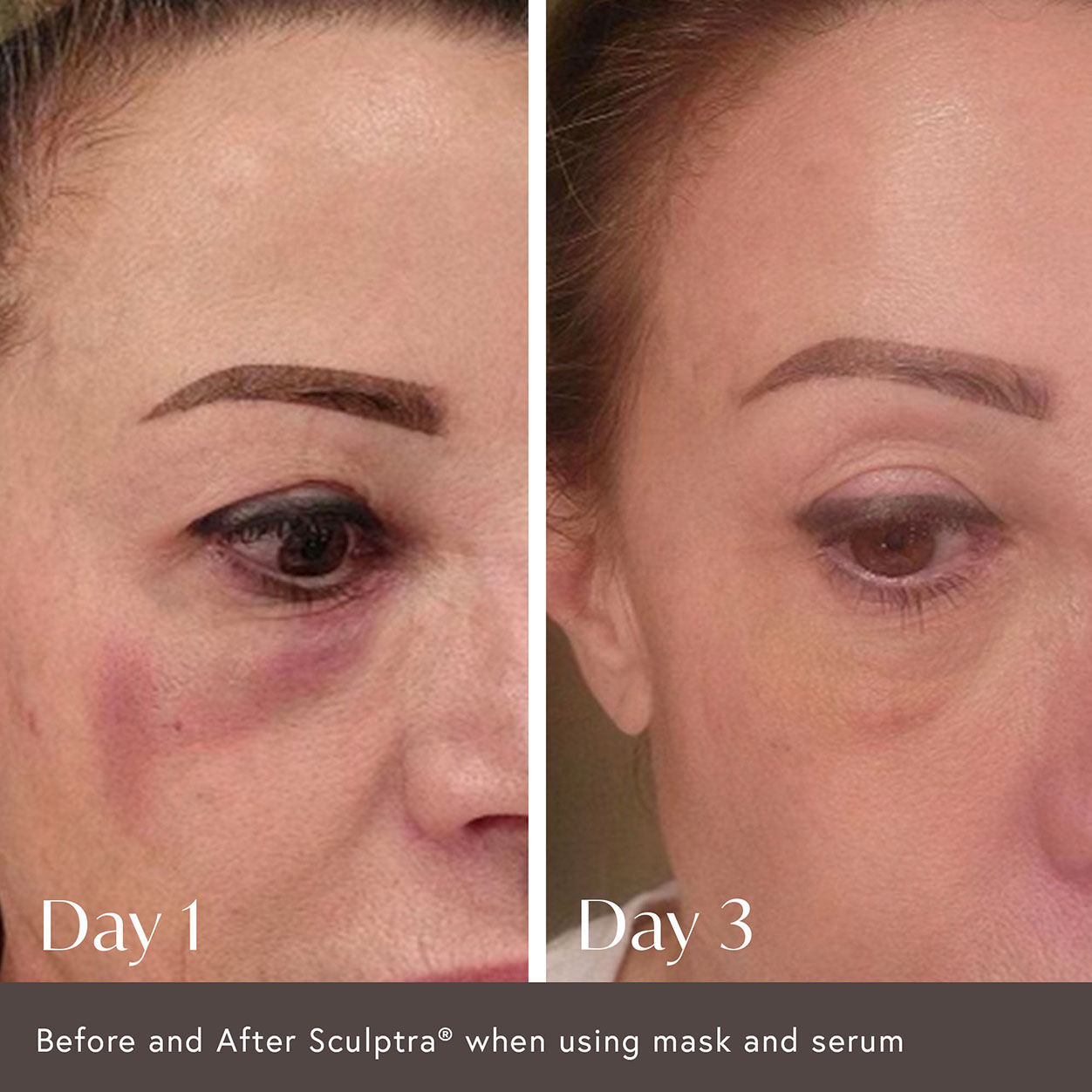 Ciao For Now Post Injection Care Mask - Hydrating & Soothing Facial Sheet for After Botox, Fillers & Cosmetic Procedures - Perfect for Post-Treatment Recovery & Skin Rejuvenation