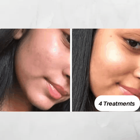 Professional Microdermabrasion Kit for Face - At-Home Skin Rejuvenation Treatment with Diamond Tip Exfoliator - Perfect for Anti-Aging, Wrinkles & Acne Scars - Spa Quality Skincare Routine
