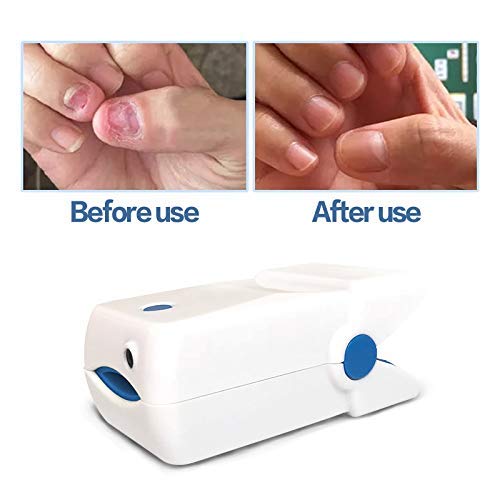 Portable Nail Therapy Treatment Device for Toenails & Fingernails - August 2024 Edition - At-Home Nail Care Solution for Fungus, Brittle Nails & Healthy Nail Growth