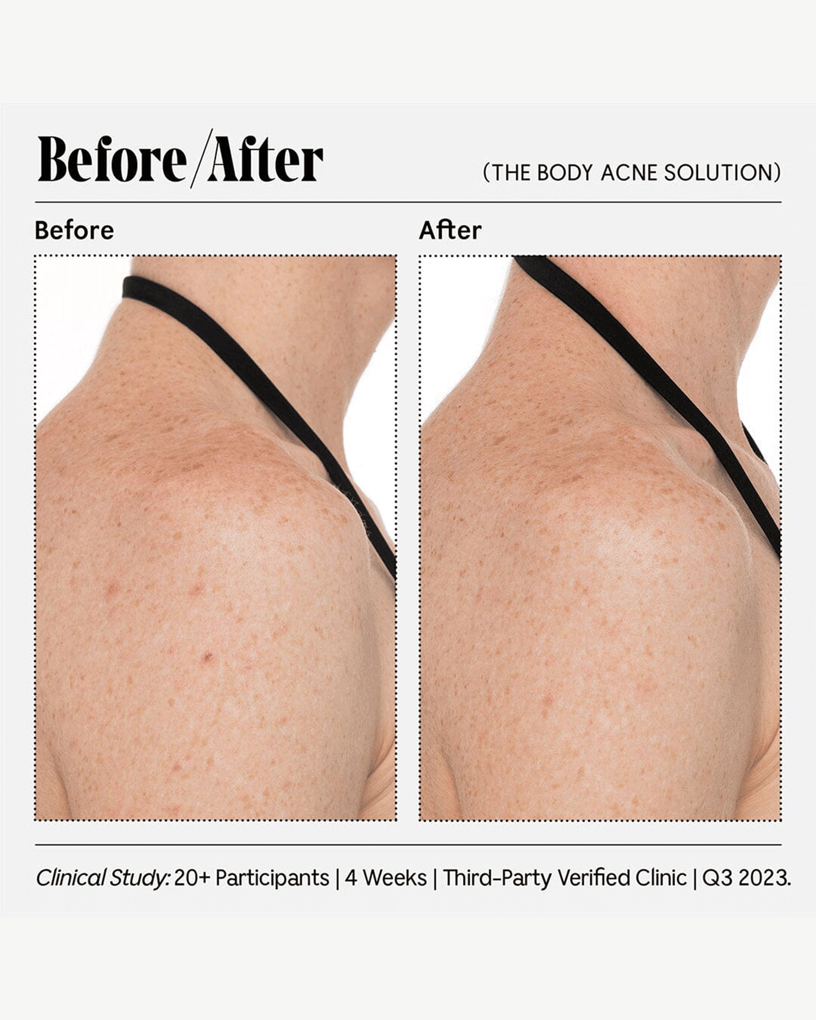 Best Acne Treatment for Body - Clear Breakouts Fast with Dermatologist-Recommended Solution | Perfect for Back, Chest & Shoulder Acne