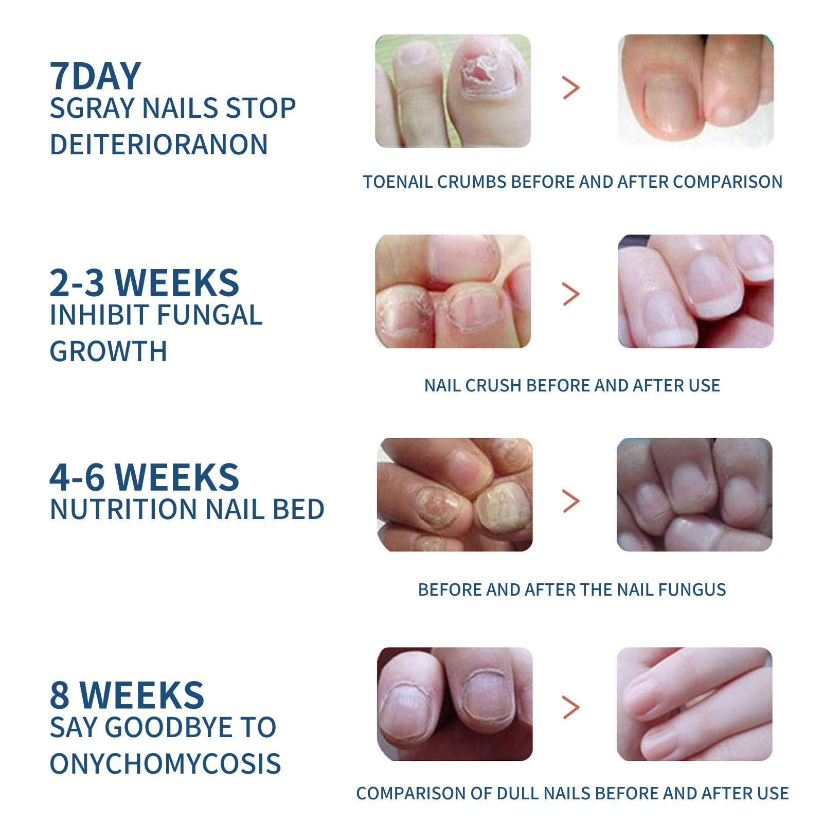 Extra Strength Toenail Fungus Treatment - 32 Pcs Antifungal Nail Patches for Damaged & Discolored Nails | 8-Hour Nighttime Renewal | Effective Fungal Infection Remedy for Healthier Looking Toenails - Perfect for Athletes, Swimmers & Active Lifestyles
