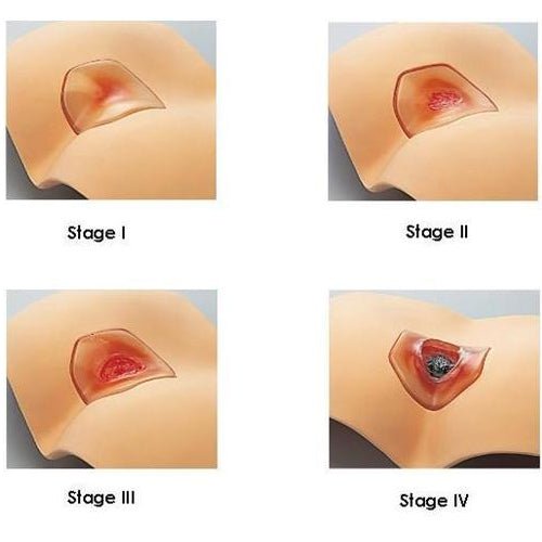 Decubitus Treatment Simulator - Medical Pressure Ulcer Care Training Device for Nurses & Healthcare Professionals | Wound Care Practice & Clinical Education
