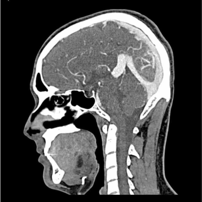 CTA AVM / Lesion Head and Neck Phantom for CT Scan & X-Ray Training - Medical Imaging Practice, Radiology Education, and Diagnostic Procedure Simulation
