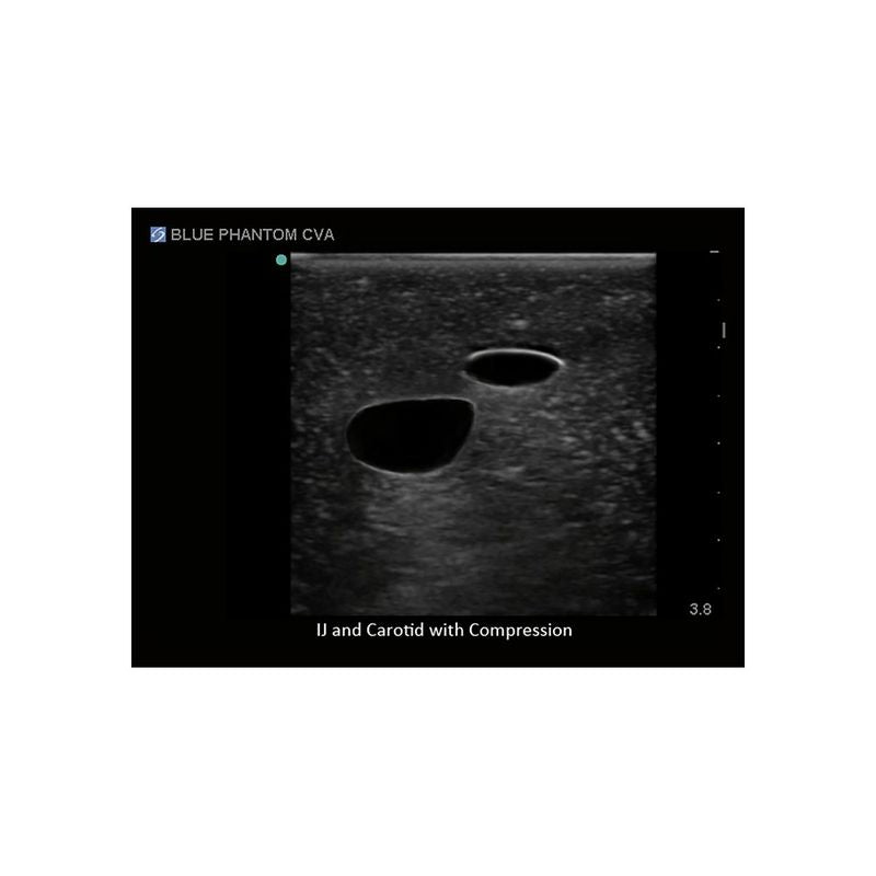Gen II Central Line and Regional Anesthesia Replacement Insert - Sterile Medical Catheter for IV Therapy & Pain Management in Hospitals & Clinics