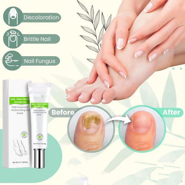 Flyles Nail Repair Treatment Gel - Restores Discolored & Damaged Nails, Strengthens & Protects Natural Nails (2 Pack) | Perfect for Manicures, Nail Care Routine & Salon Treatments