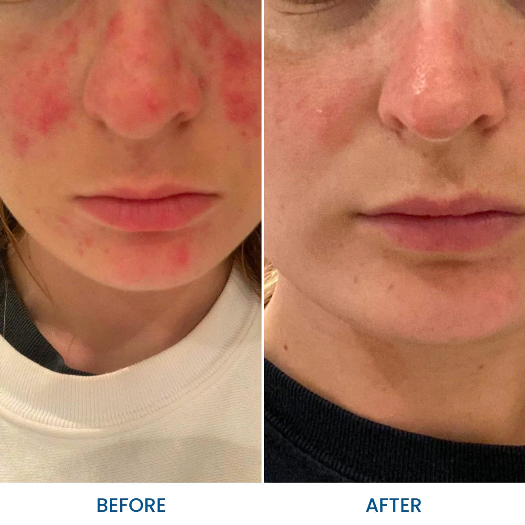 Best Natural Acne Treatment Gel for Clear Skin | Organic & Effective Acne Spot Remover | Perfect for Teen & Adult Acne Care at Home
