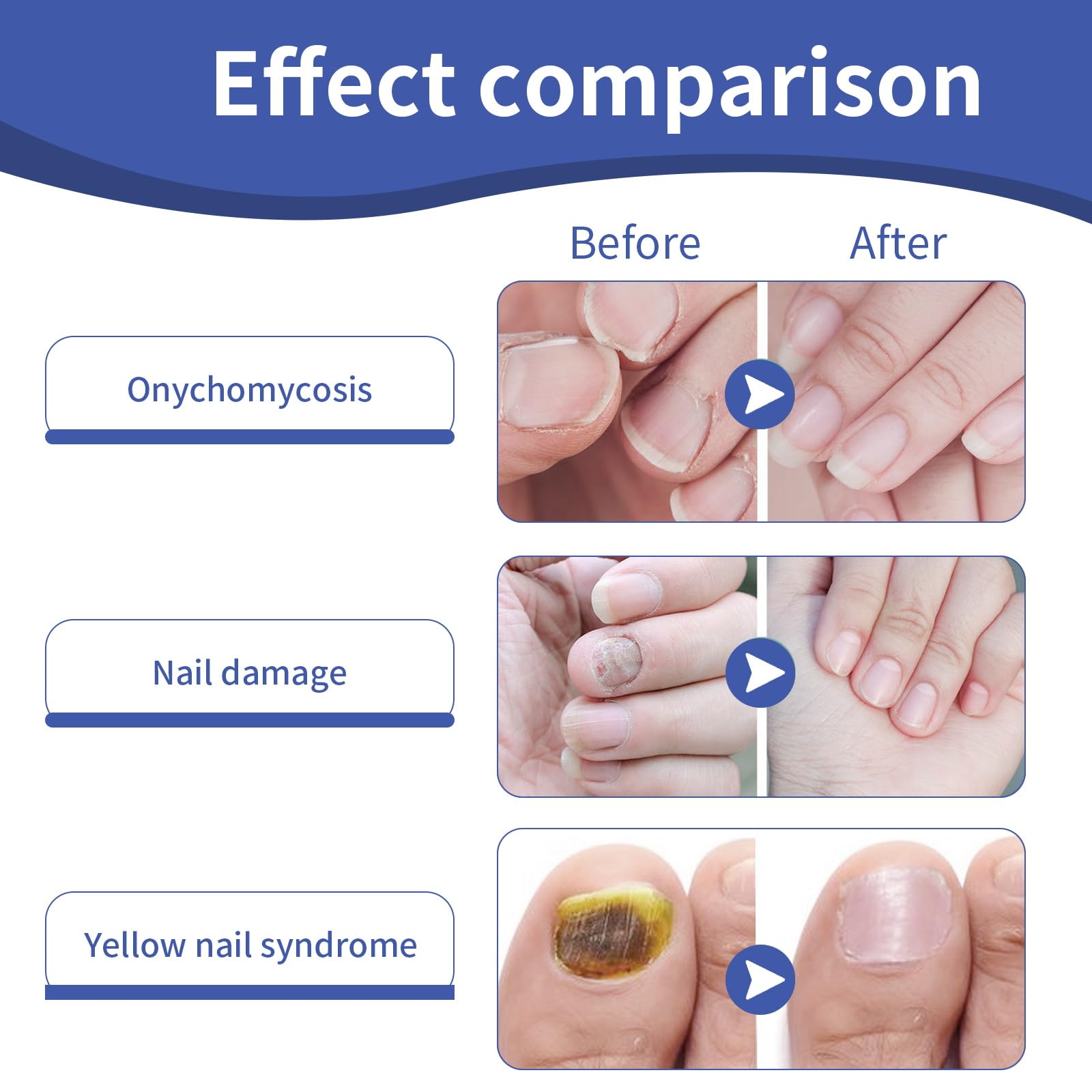 Extra Strength Toenail Fungus Treatment - 32 Pcs Antifungal Nail Patches for Damaged & Discolored Nails | 8-Hour Overnight Renewal | Effective Nail Fungus Remover for Athlete's Foot & Toenail Restoration | Home Foot Care Solution