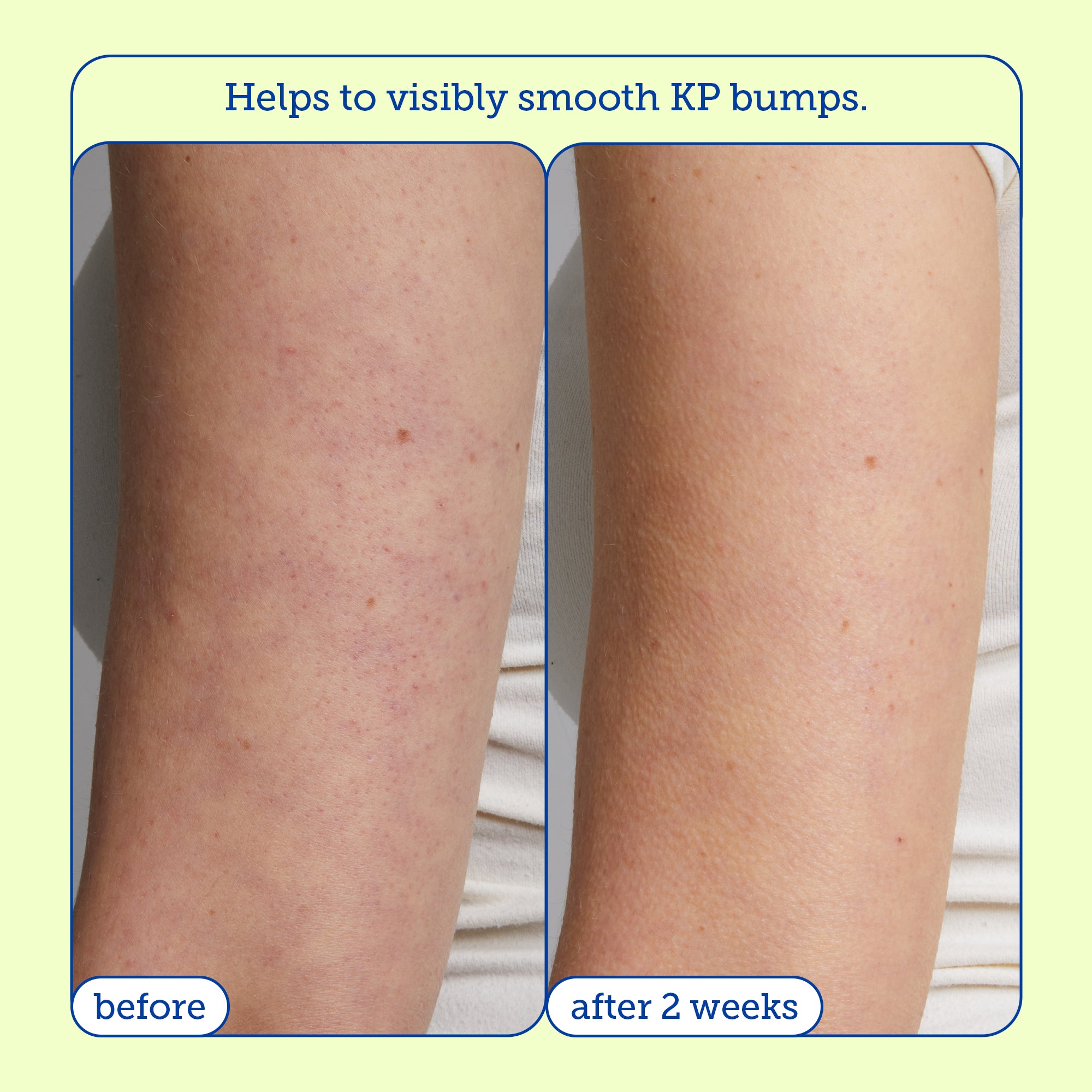 Resurface KP & PsO Smoothing Body Treatment Cream for Keratosis Pilaris & Psoriasis Relief – Exfoliating Moisturizer for Dry, Bumpy Skin – Ideal for Arms, Legs & Body Care Routine