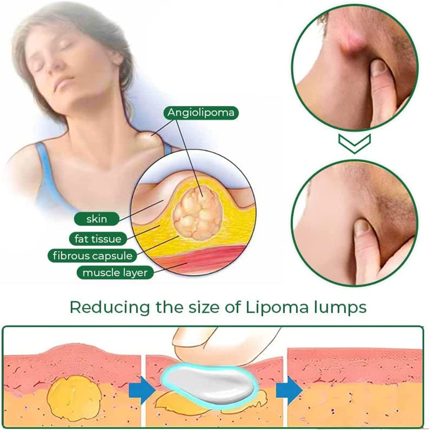 LipomaCure Soothing Ointment - 2 Pack Lump Removal Cream for Lipomas | Natural Lipoma Treatment for Arms, Legs & Body | Fast-Acting Lumps Relief Solution for Home & Travel Use