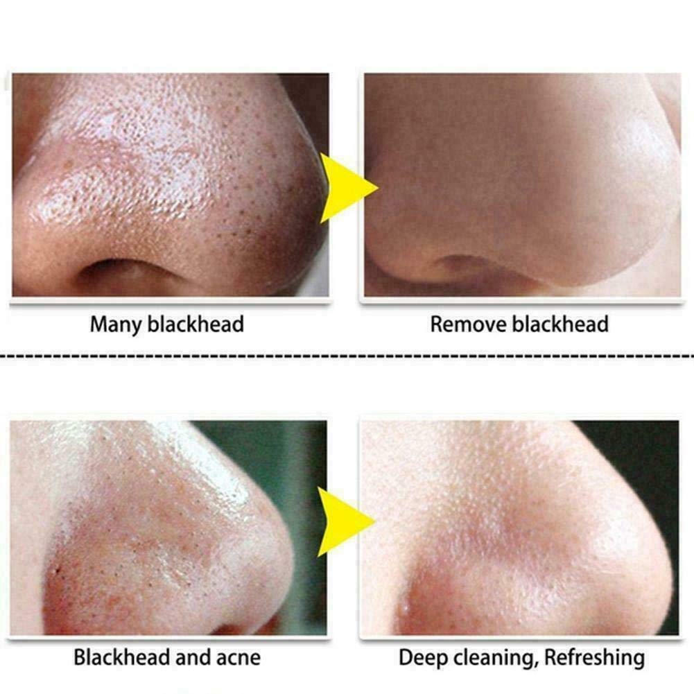 Pure Natural Aloe Vera Gel for Blackhead & Acne Treatment - Deep Cleansing Nasal Mask & Peeling Gel to Remove Blackheads, Shrink Pores (22g) | Perfect for Daily Skincare & Pore Refining Routine