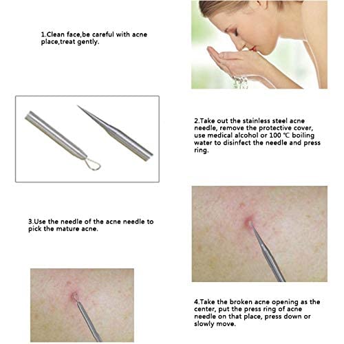 MAPPERZ Blackhead & Acne Removal Kit - 4 Pc Professional Comedone Extractor Tools for Whiteheads & Pimples on Nose & Face (Includes Storage Case) - Perfect for At-Home Skincare Routine & Spa Treatments