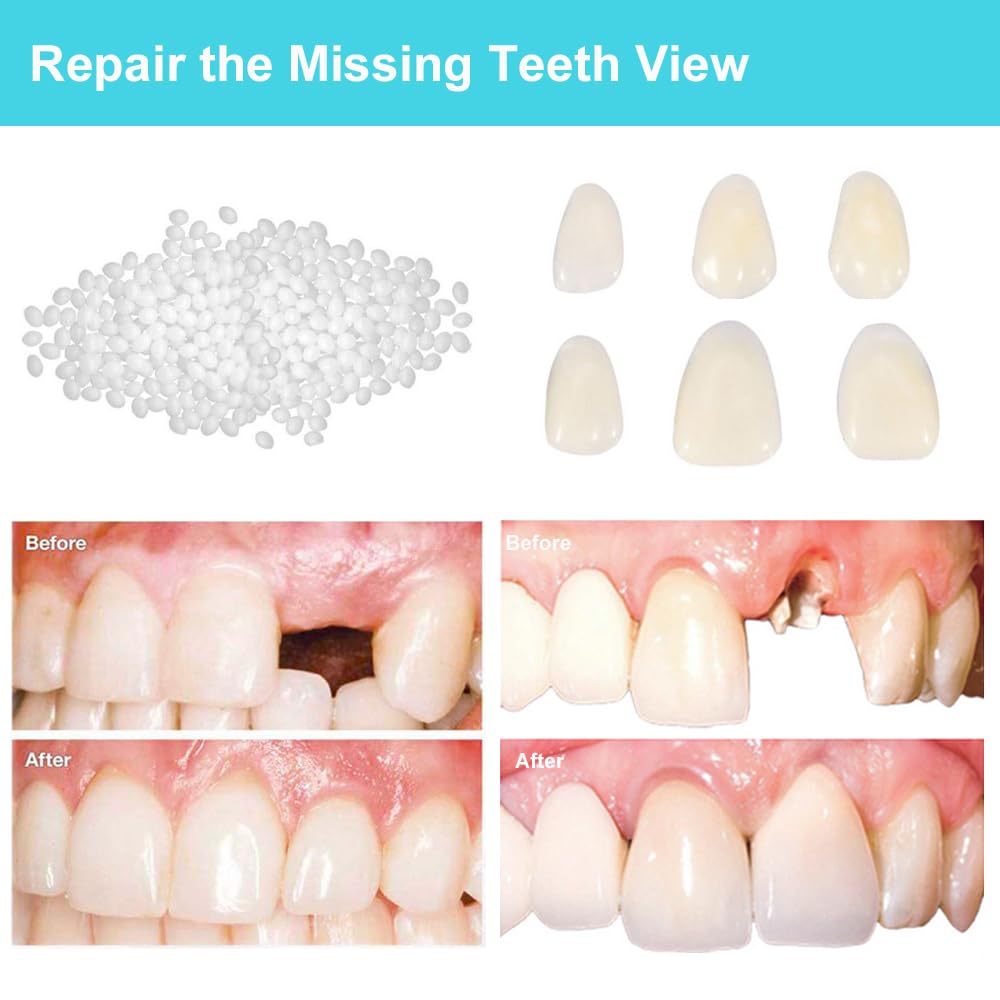 Dental Repair Kit for Missing & Broken Teeth - Moldable Fake Teeth & Thermal Beads Replacement - Perfect for Emergency Tooth Filling & Gap Repair at Home, Travel, or Outdoor Activities