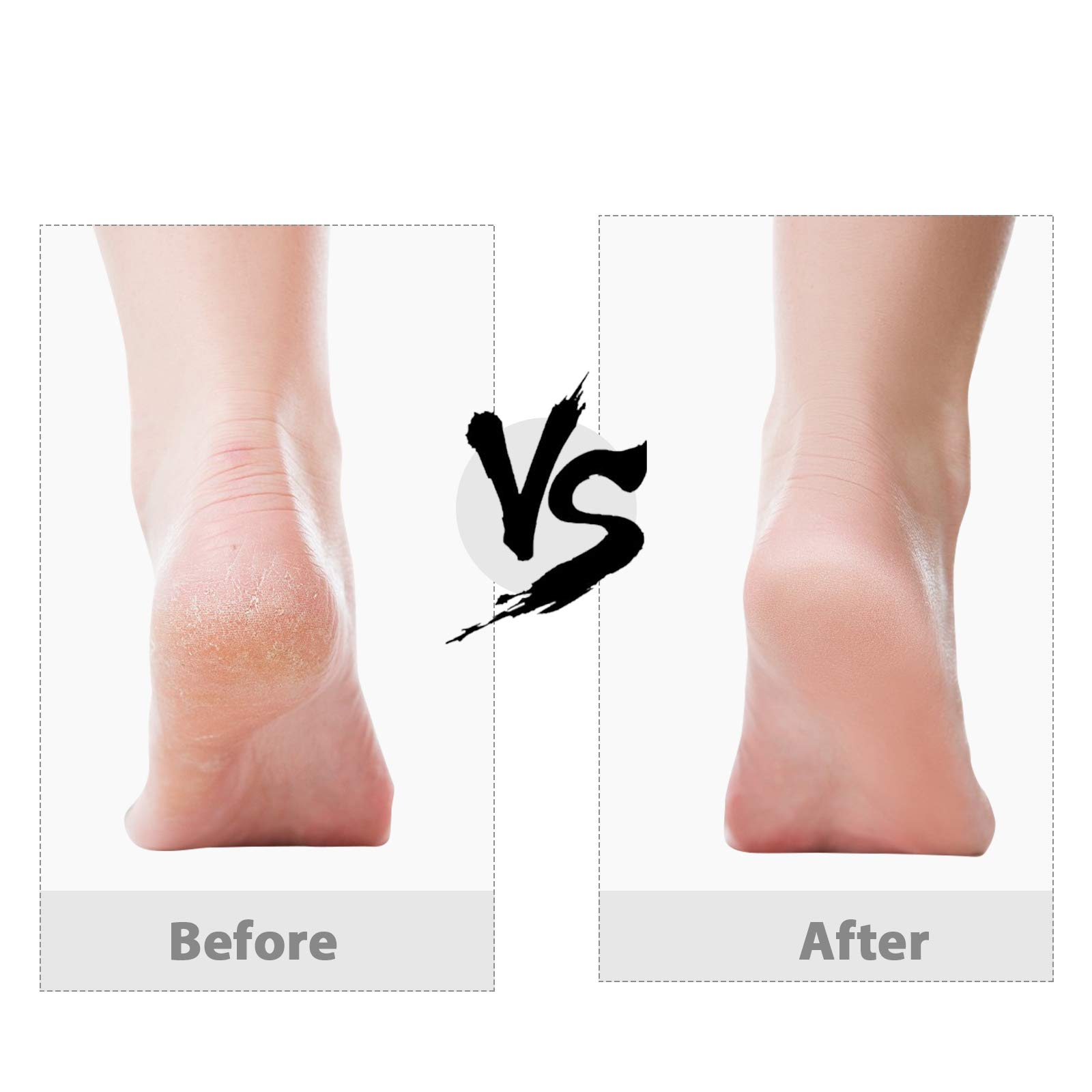Keenove Rechargeable Electric Foot File - Dual Speed Callus Remover for Smooth Feet at Home Spa