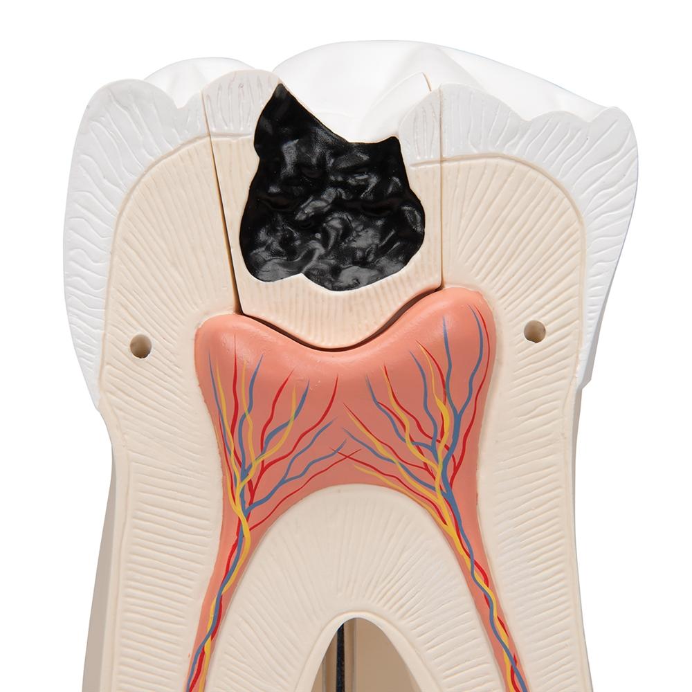 Giant Molar with Cavities - 15x Life Size Dental Model (5-Part) - Perfect for Dental Education, Classroom Demonstrations & Medical Training