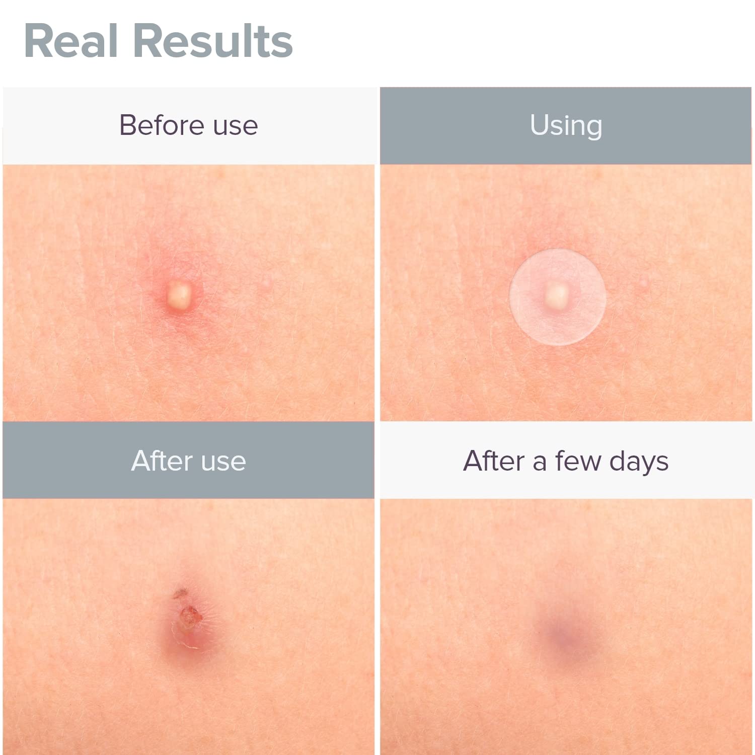 PRIVEDA Acne Pimple Patch - 57 Hydrocolloid Patches for Face (8mm/10mm/12mm) | Korean Made, Waterproof Spot Treatment for Overnight Healing | Perfect for Teen & Adult Acne, Whiteheads & Blackheads