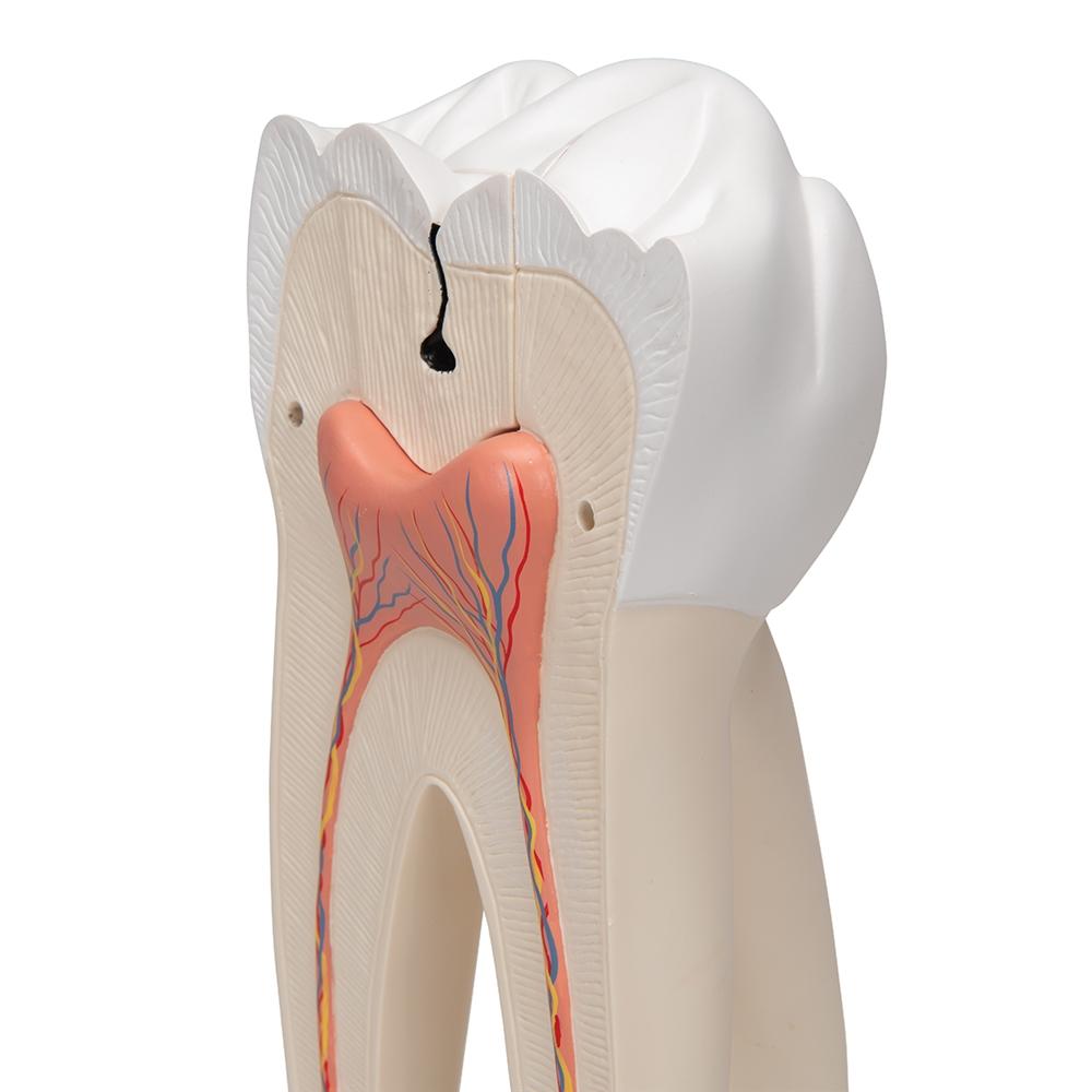 Giant Molar with Cavities - 15x Life Size Dental Model (5-Part) - Perfect for Dental Education, Classroom Demonstrations & Medical Training