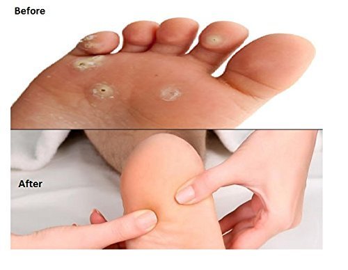 Professional Callus Remover for Feet - Corn & Hard Skin Shaver Pedicure Kit with 25 Blades - Effective Foot Care for Smooth Heels & Toes - Perfect for Home Pedicures & Salon Use
