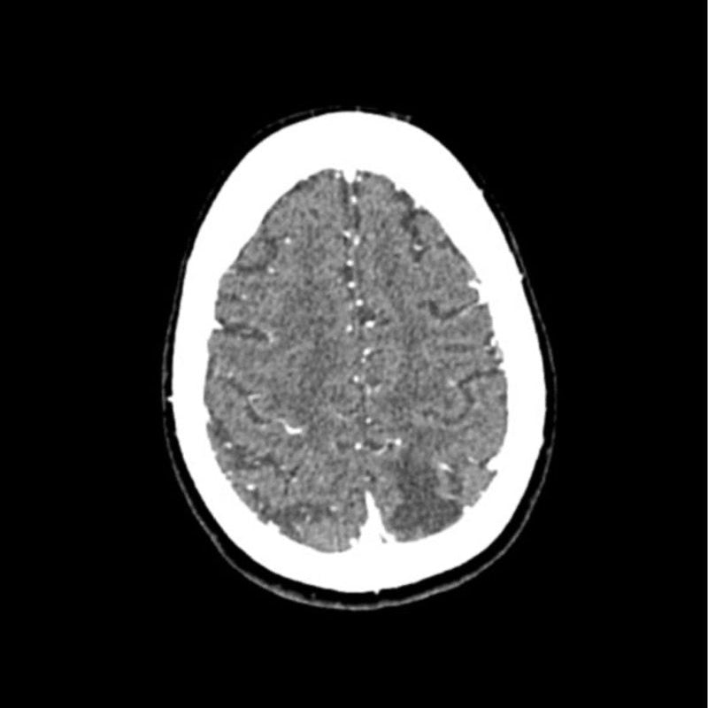 CTA Aneurysm Head Phantom for CT Scan and X-Ray Training - High-Quality Medical Simulation Tool for Radiology Education and Diagnostic Practice