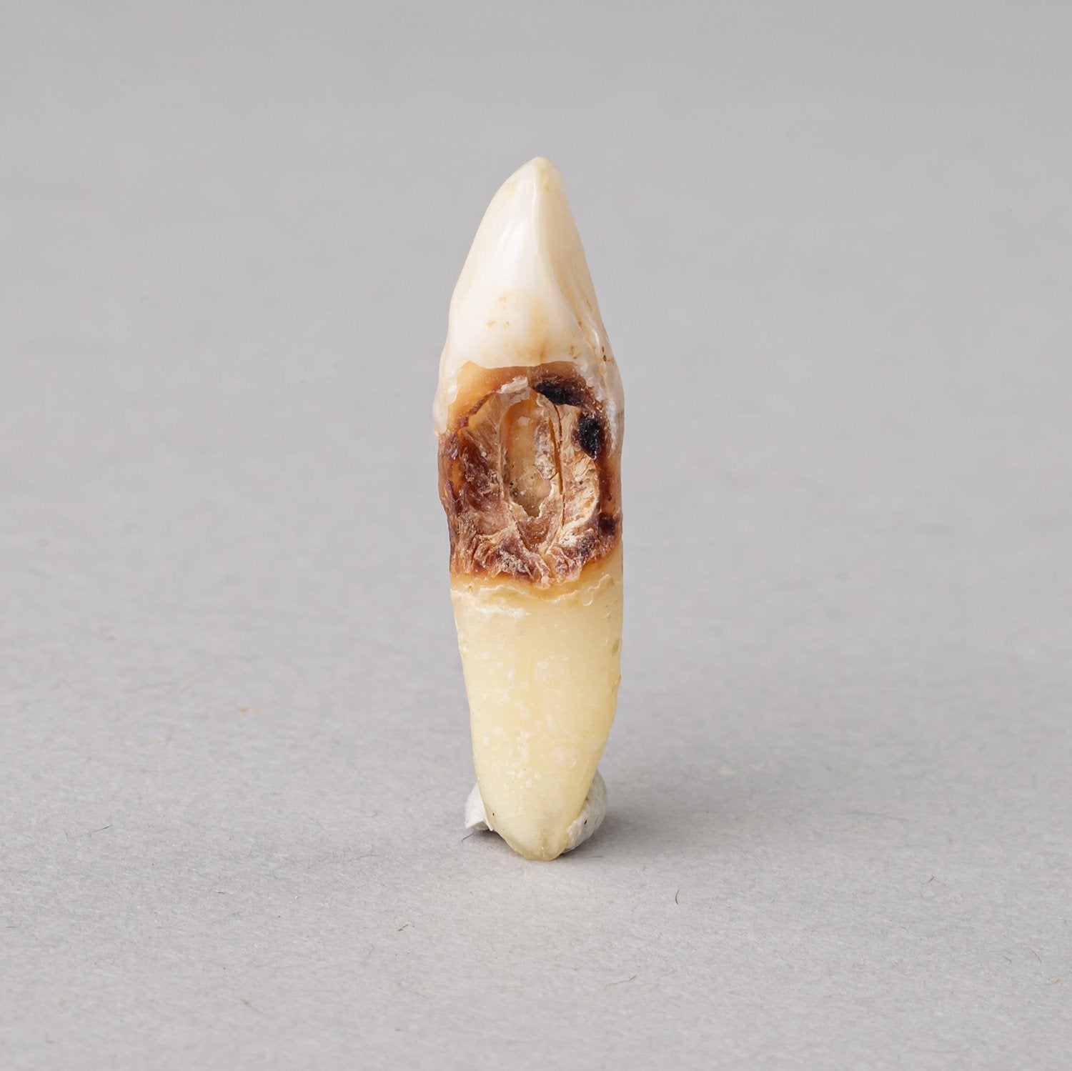 Real Human Tooth with Decay - Single Specimen for Dental Education, Medical Study & Forensic Analysis | Perfect for Dental Students, Anatomy Classes & Science Projects